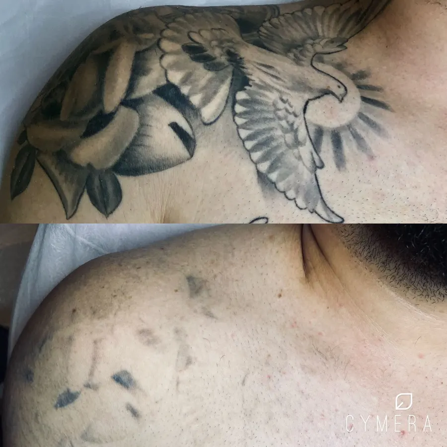 Antes e depois — remoção de tatuagem no ombro