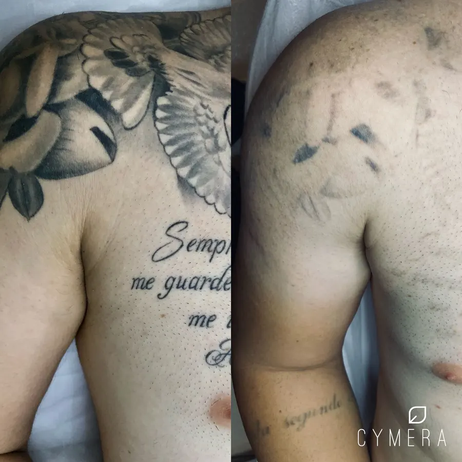 Antes e depois — remoção em andamento