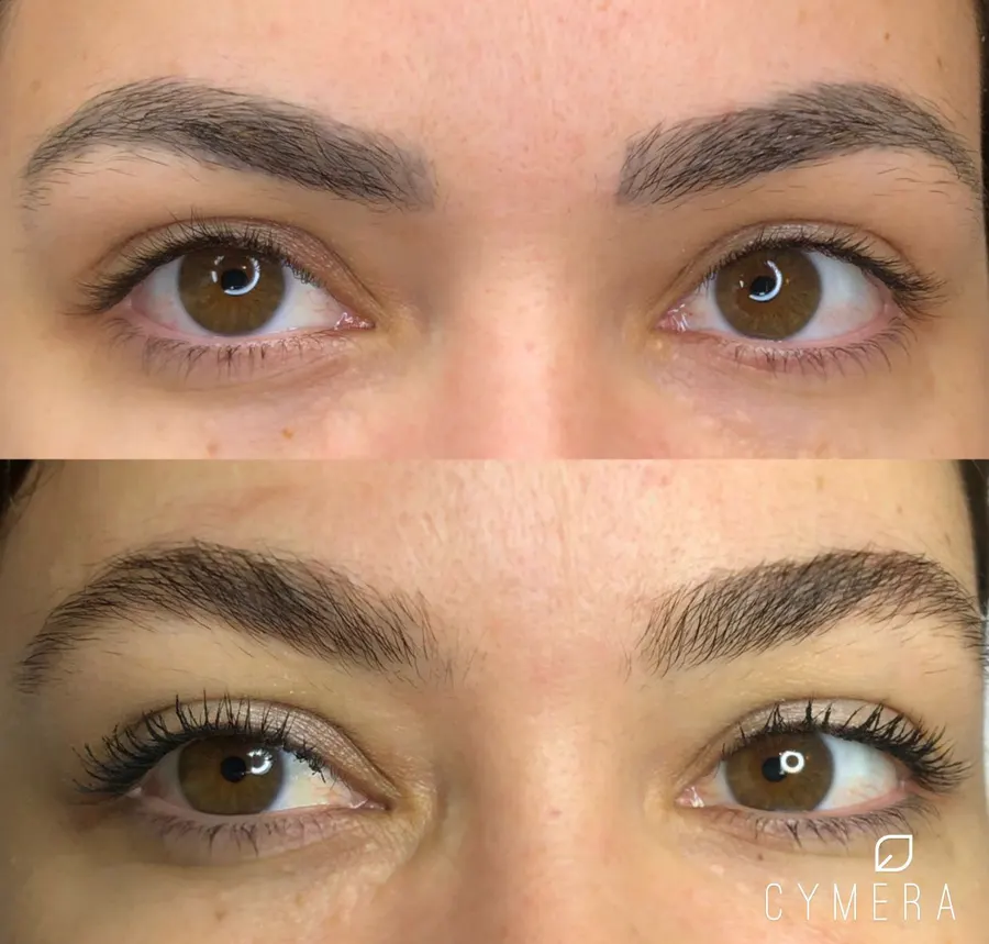 Antes e depois — sobrancelhas com micropigmentação removida