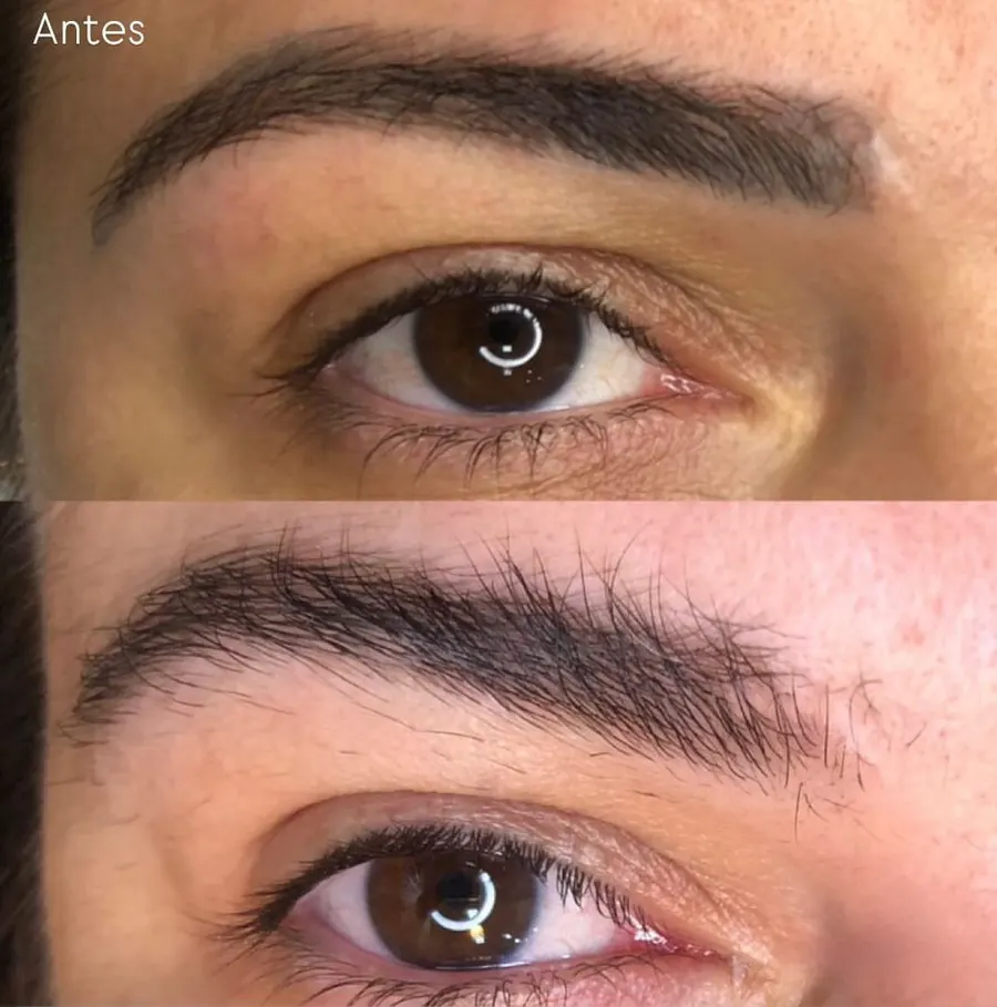 Antes e depois — remoção de tatuagem