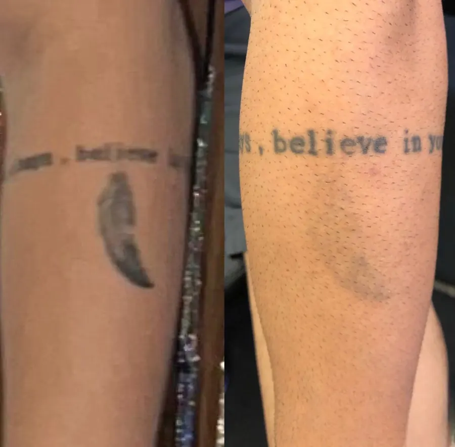 Antes e depois — micropigmentação corrigida